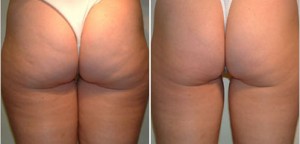  Anuncios gratis en Santiago |  MASAJES REDUCTIVOS DESDE 80.000 12 SESIONES... 100% EFECTIVOS. 09 830 61 50, TRATAMIENTOS, YESOTERAPIA.RESULTADOS VISIBLES DESDE LAS PRIMERAS SESIONES