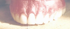 CIRUJANO DENTISTA Anuncios gratis en La Serena |  PR&Oacute;TESIS ACR&Iacute;LICAS $19.000. FLEXIBLES. AYAL&Eacute;N 3484 LAS COMPA&Ntilde;IAS. 76013148, ODONTOLOG&Iacute;A SOCIAL  AL SERVICIO COMUNITARIO. PROFESIONALES UNIVERSITARIOS