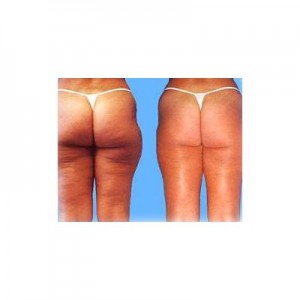 Claudia Gallo Anuncios gratis en Providencia |  Drenaje linf&aacute;tico post operatorio ultrasonido linfedema , Cavitaci&ograve;n con drenaje y radiofrecuencia