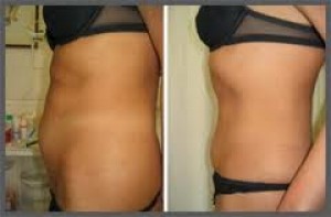  Anuncios gratis en Las Condes |  mesostabyl tratamientos de mesoterapia inyectable, a domicilio